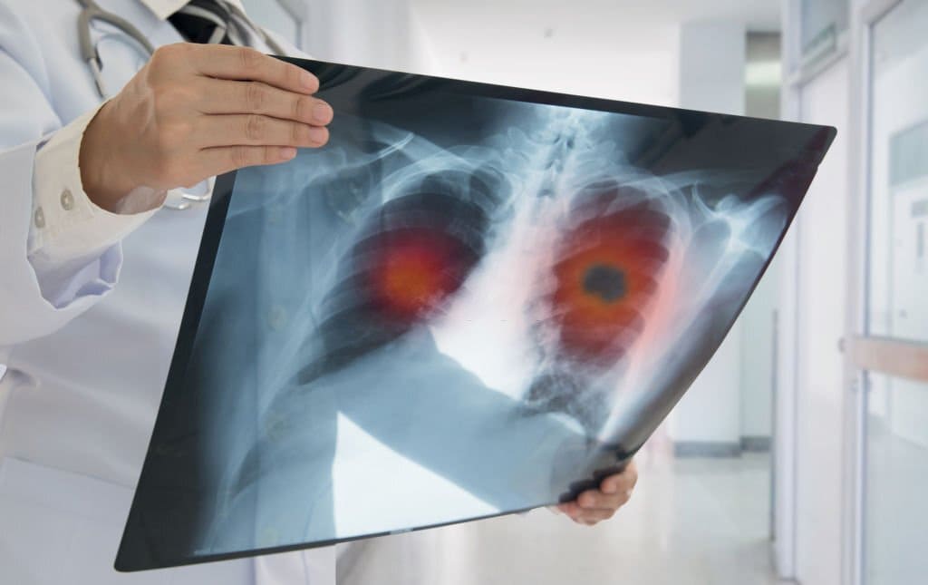Detección oportuna del cáncer